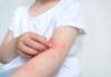 FDA Issues URGENT Recall on Popular Eczema Cream Child's arm showing skin irritation and redness