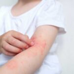 FDA Issues URGENT Recall on Popular Eczema Cream Child's arm showing skin irritation and redness