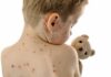 Child with red spots on back holding a teddy bear