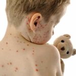 Explosive Outbreaks Hit Dozens Of States Child with red spots on back holding a teddy bear