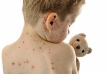 Child with red spots on back holding a teddy bear