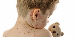 Child with red spots on back holding a teddy bear